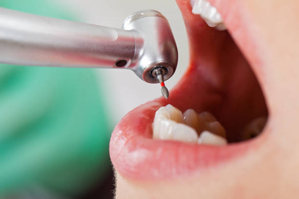 Best Emergency Tooth Extraction in West St Paul, MN